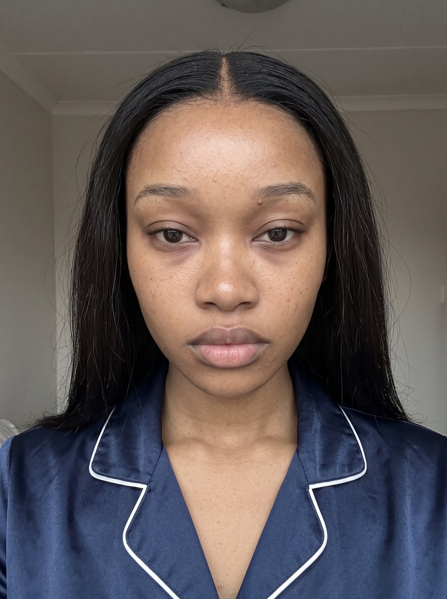 Brighter, More Even-Looking Skin — before