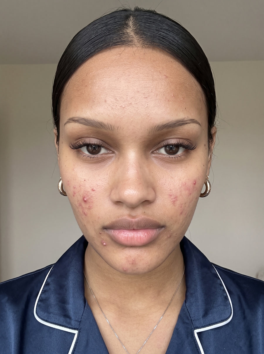 Clearer-Looking Skin — before